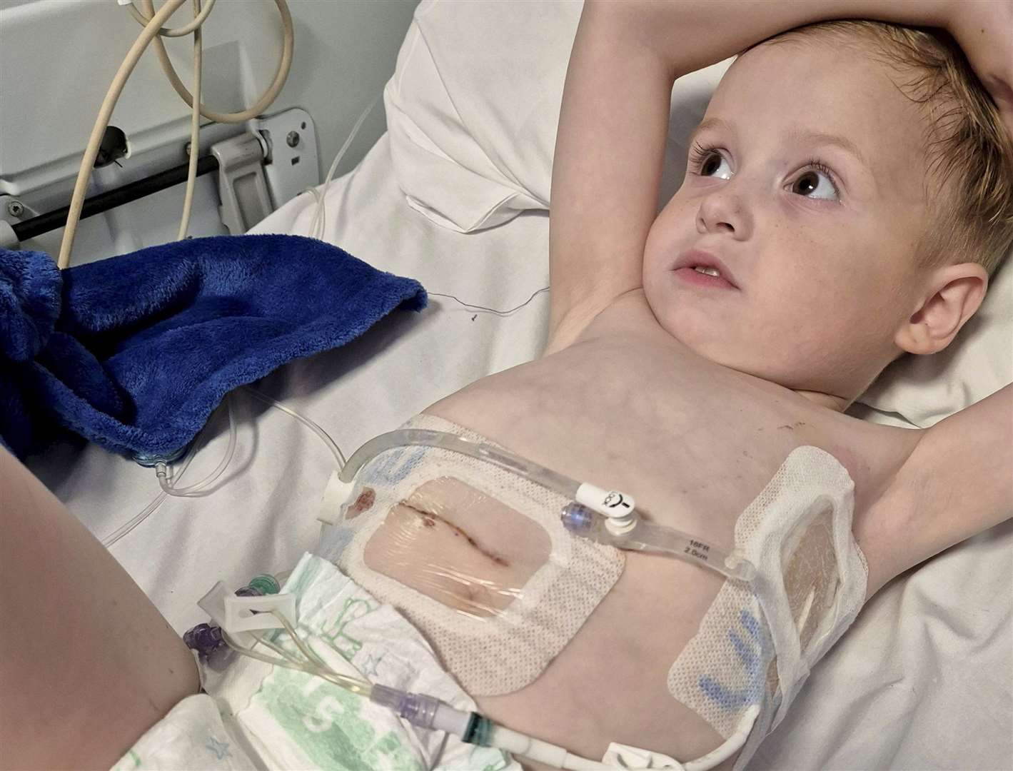 Henley Mountford-Farmer had to have emergency surgery at hospital when he was just two-years-old. Picture: SWNS