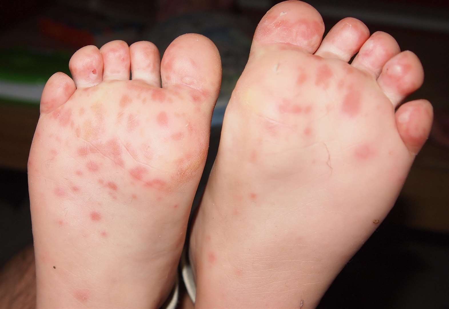 Can Hand Foot And Mouth Rash Be On Arms And Legs